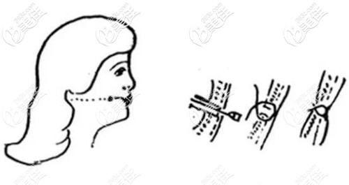 埋線酒窩成形術(shù)原理 埋線酒窩成形術(shù)原理