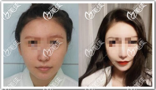 面部脂肪加減術(shù)圖片 面部脂肪加減術(shù)圖片