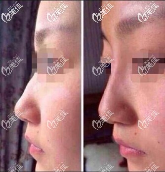 駝峰鼻打玻尿酸真實案例 駝峰鼻打玻尿酸真實案例