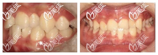 牙齒深覆合矯正前圖示 牙齒深覆合矯正前圖示
