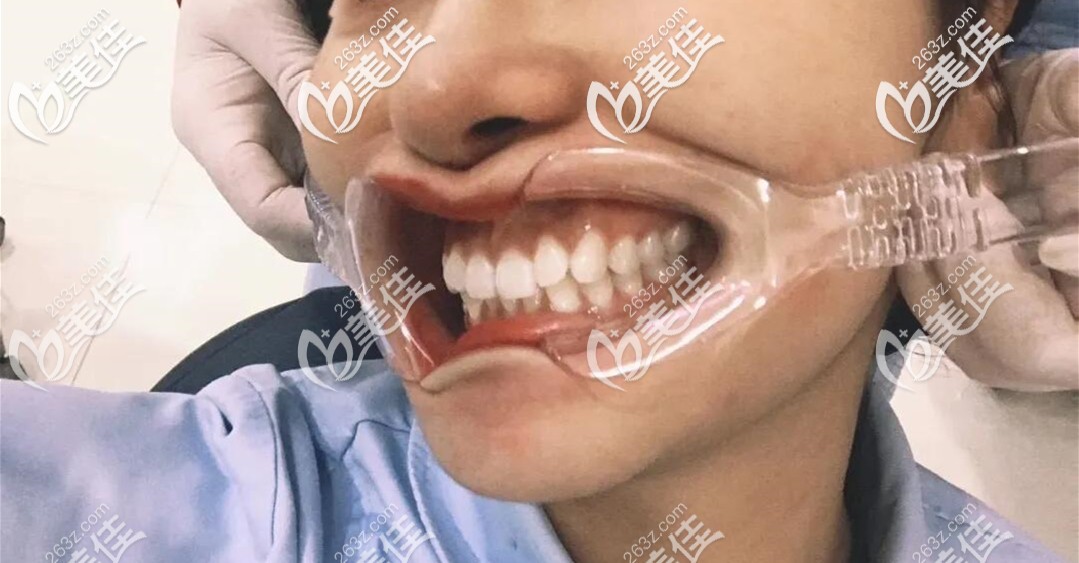 戴隱形牙套第100天 戴隱形牙套第100天