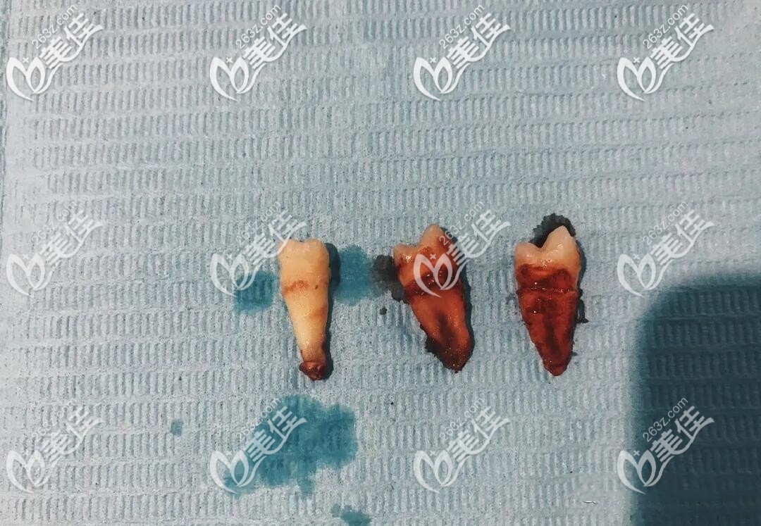 拔牙矯正深覆合 拔牙矯正深覆合