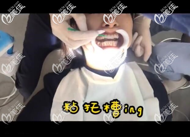 醫(yī)生粘托槽過程 醫(yī)生粘托槽過程