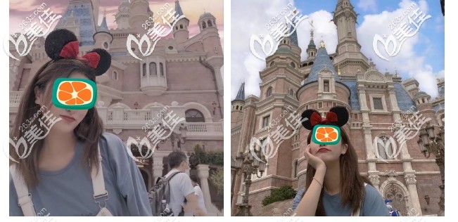 前牙深覆合得到明顯解決 前牙深覆合得到明顯解決