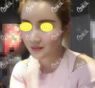 面部自體脂肪移植填充術后17天效果照