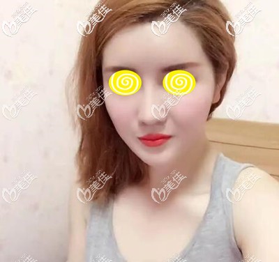 面部自體脂肪移植填充術后33天效果照