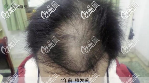 4年前植發(fā)前頭頂頭發(fā)稀疏 4年前植發(fā)前頭頂頭發(fā)稀疏