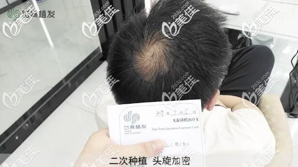 二次種植頭旋加密 二次種植頭旋加密