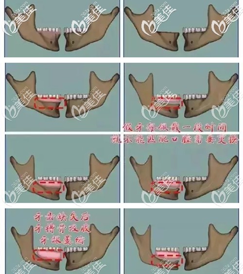 長(zhǎng)期戴活動(dòng)假牙的牙槽骨變化圖 長(zhǎng)期戴活動(dòng)假牙的牙槽骨變化圖