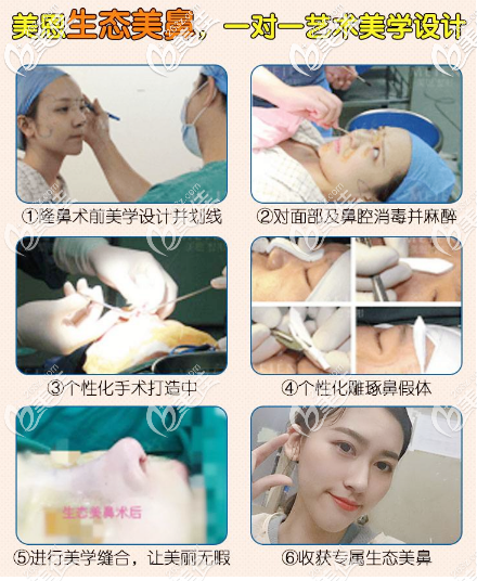 廣東美恩張勇院長(zhǎng)隆鼻手術(shù)過(guò)程案例圖片 廣東美恩張勇院長(zhǎng)隆鼻手術(shù)過(guò)程案例圖片