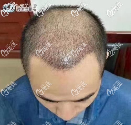 術(shù)后第四個(gè)月頭發(fā)還是稀疏 術(shù)后第四個(gè)月頭發(fā)還是稀疏