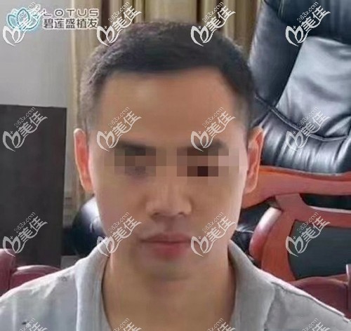 m型發(fā)際線植發(fā)四個(gè)多月還是稀稀拉拉,植發(fā)六個(gè)月密度沒上來,到九個(gè)月區(qū)別效果亮了!