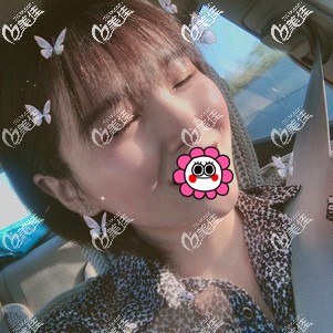 肋軟骨隆鼻7天拆線后 肋軟骨隆鼻7天拆線后