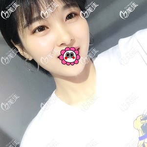 花三萬(wàn)多做了自體肋軟骨隆鼻一點(diǎn)都不后悔，分享一下我恢復(fù)三個(gè)月的經(jīng)歷