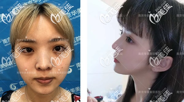 南京華美曹海峰鼻子案例 南京華美曹海峰鼻子案例