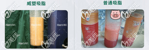 北京韓嘯威塑吸脂術中脂肪情況示意圖 北京韓嘯威塑吸脂術中脂肪情況示意圖