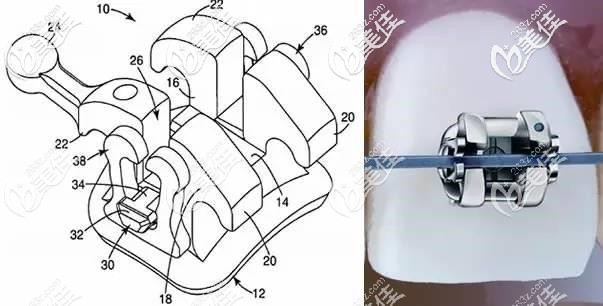 自鎖托槽圖解 自鎖托槽圖解