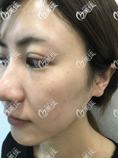 祛斑前的我 祛斑前的我