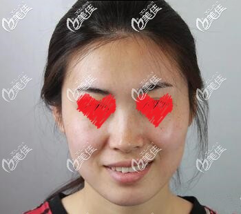 玻尿酸填充面部術(shù)前照 玻尿酸填充面部術(shù)前照