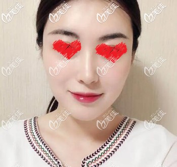 額頭扁平有淚溝的我找遼寧曙光劉春曉做了玻尿酸填充后效果真心不錯(cuò)，一共打了10ml！