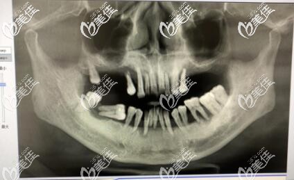 ?還在問蘇州種植牙哪里好?50歲牙周炎全口牙松動的她選擇昆山美奧還給減免費用