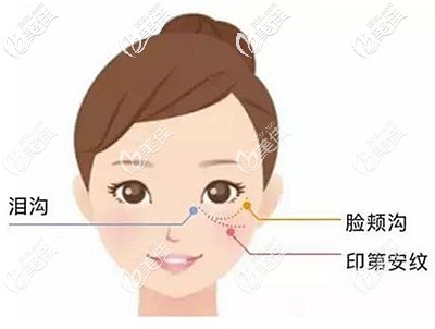 印第安紋所在的面部位置