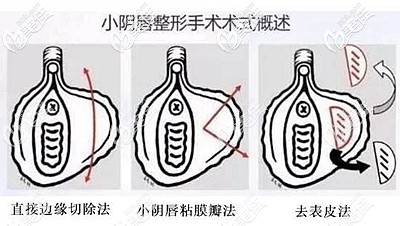 小陰唇縮小手術(shù)的方法 小陰唇縮小手術(shù)的方法