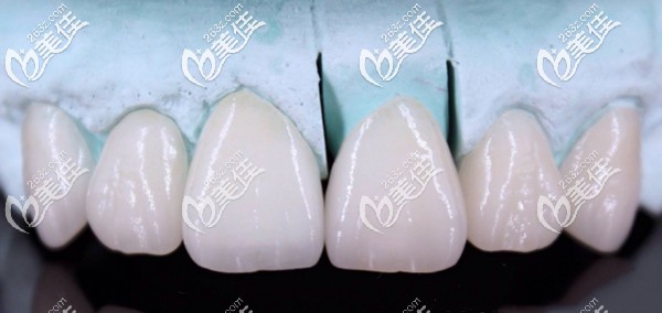 石膏工作模上做的鑄瓷美學(xué)貼面