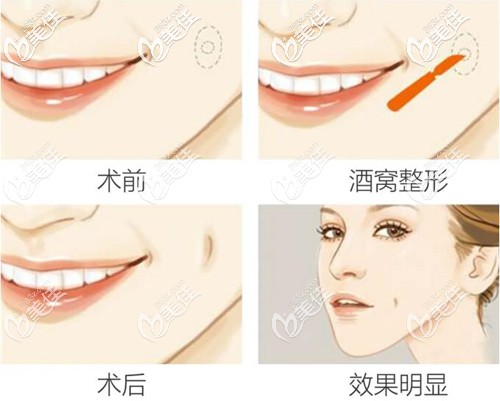 埋線酒窩成形術(shù)原理 埋線酒窩成形術(shù)原理