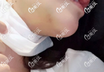 剛拆完線的下巴