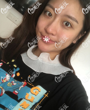 我在重慶好美做完硅膠墊下巴20天