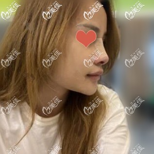 鼻修復(fù)術(shù)后當天照