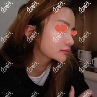 花了3萬多在泰國TARA CLINIC整形醫(yī)院做的鼻修復(fù)手術(shù)效果大家看下覺得怎么樣？