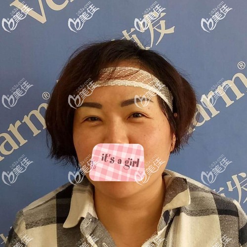 種植眉毛術后即刻效果 種植眉毛術后即刻效果