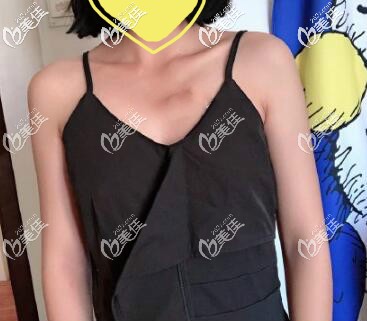 假體隆胸術(shù)前圖片