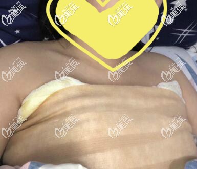 假體隆胸術(shù)后3天樣子