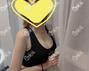 做曼托水滴235cc假體隆胸一個(gè)月療效圖片