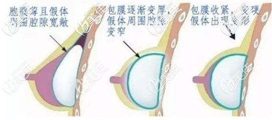 假體隆胸手術(shù)后包膜攣縮 假體隆胸手術(shù)后包膜攣縮