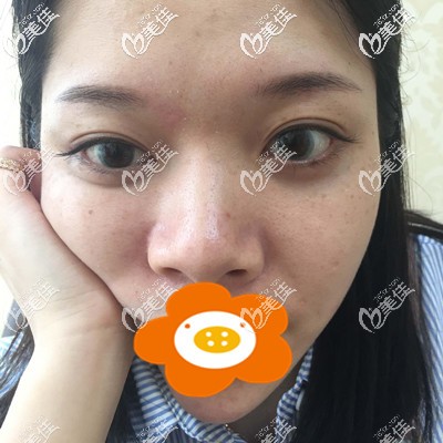 這是做隆鼻手術(shù)前的我 這是做隆鼻手術(shù)前的我