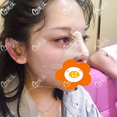 剛做完手術(shù)的丑樣 剛做完手術(shù)的丑樣