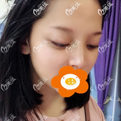 做完隆鼻手術(shù)后一周 做完隆鼻手術(shù)后一周