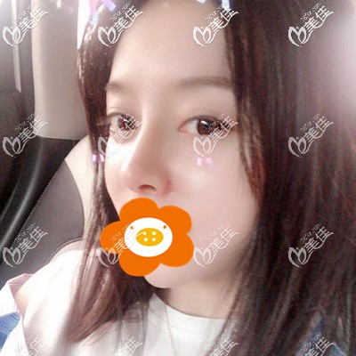 術(shù)后一個月打卡 術(shù)后一個月打卡