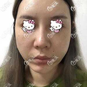 臉上面部脂肪偏多顯臉大 臉上面部脂肪偏多顯臉大