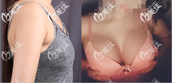 閨蜜在蘭州時光傲諾拉225cc假體隆胸1年前后效果對比照片 閨蜜在蘭州時光傲諾拉225cc假體隆胸1年前后效果對比照片