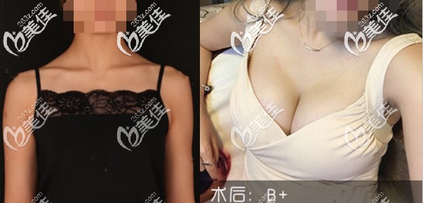 都是A罩杯的乳房,用的也都是傲諾拉225cc璀璨水滴形假體,為啥恢復(fù)后我是B+,閨蜜卻是D杯呢?