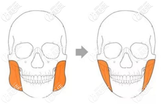 切除咬肌的手術(shù)方法 切除咬肌的手術(shù)方法