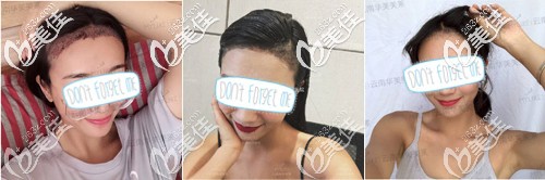 了解昆明植發(fā)哪家好之前,先看云南華美美萊俞滿昌發(fā)際線種植效果怎么樣?