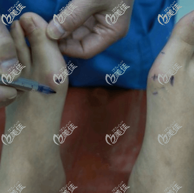 北京圣嘉新蘇敬達醫(yī)生給我做微孔祛大腳骨手術當天