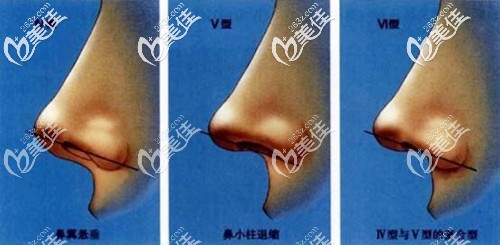 鼻小柱下垂的幾種情況 鼻小柱下垂的幾種情況