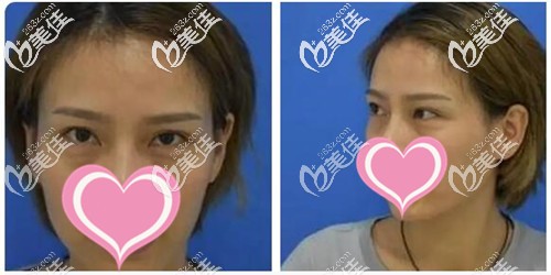 外切去眼袋手術(shù)前 外切去眼袋手術(shù)前